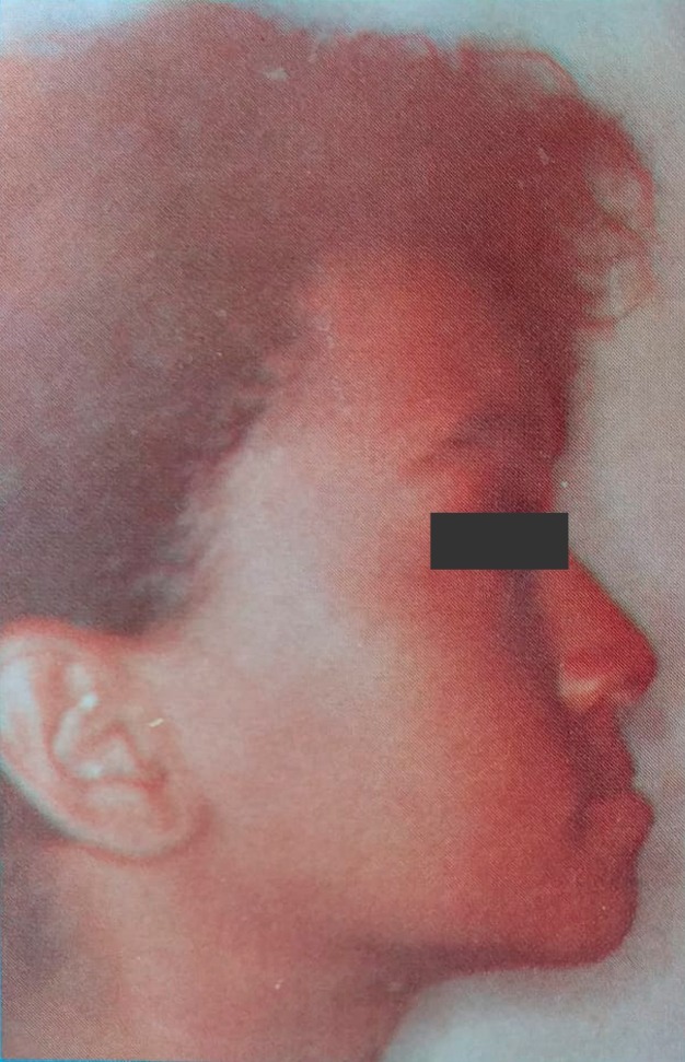 Caso 2 antes — prognatismo mandibular