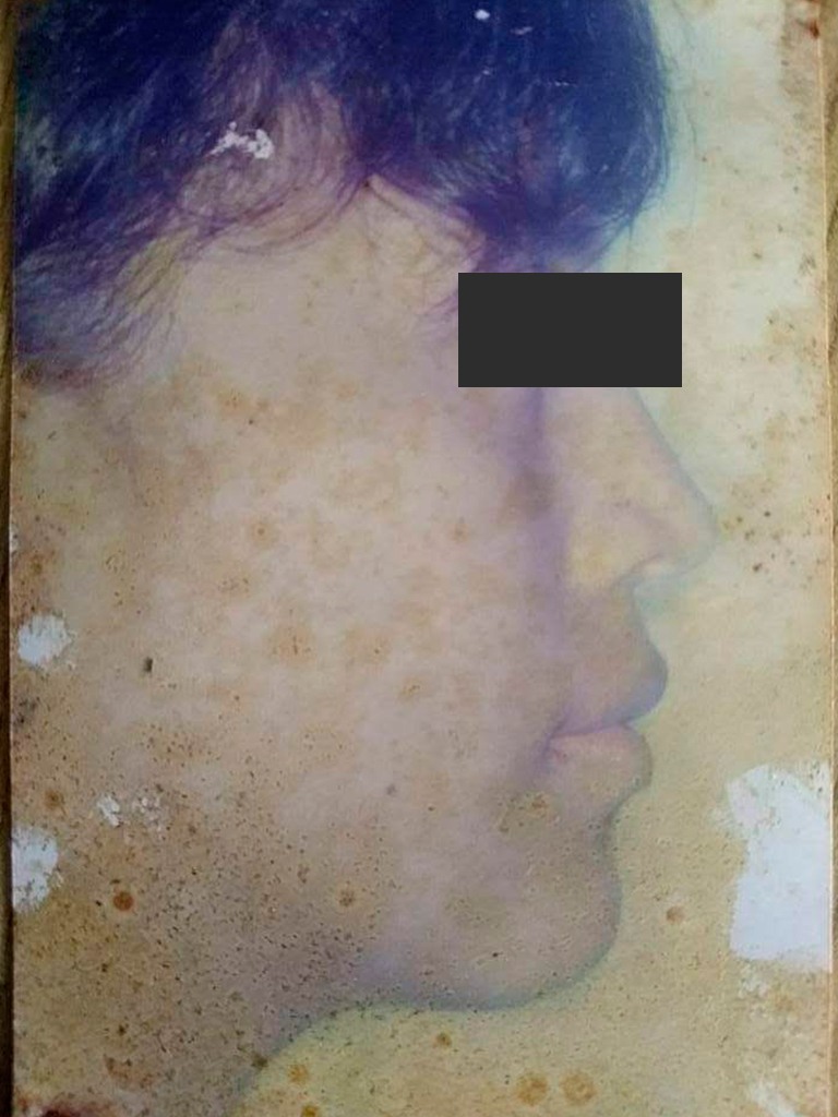 Caso 3 después — perfil armónico