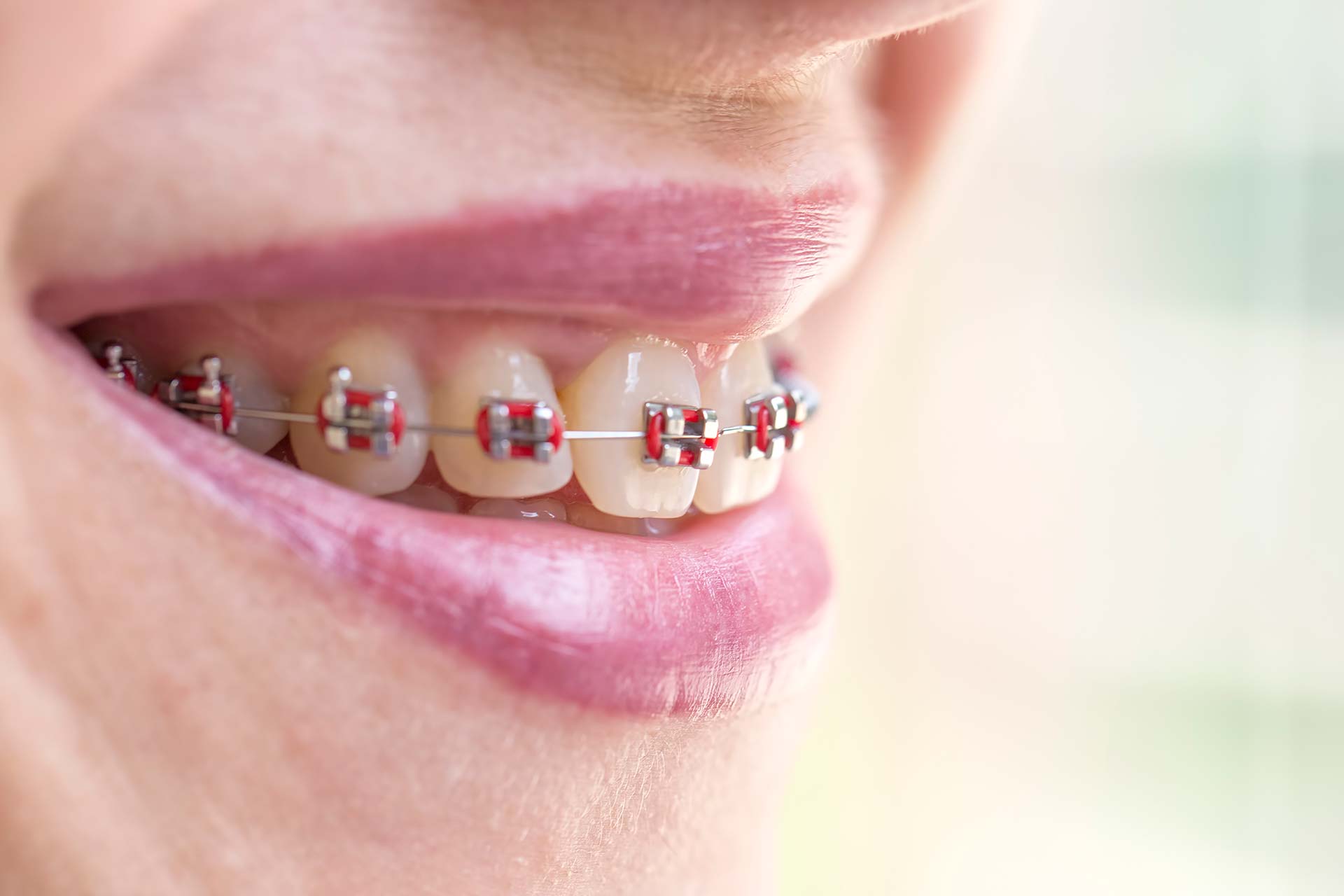 Sonrisa con brackets metálicos — ortodoncia en Acapulco