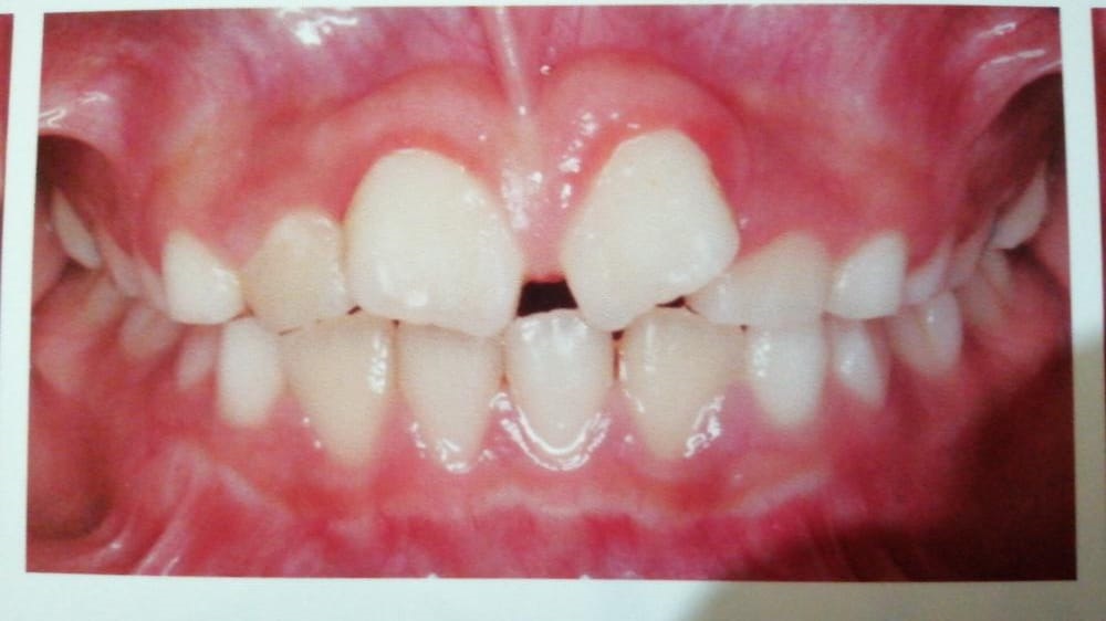 Caso de ortopedia dentofacial — antes