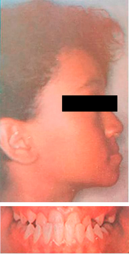 Caso de ortopedia dentofacial — antes