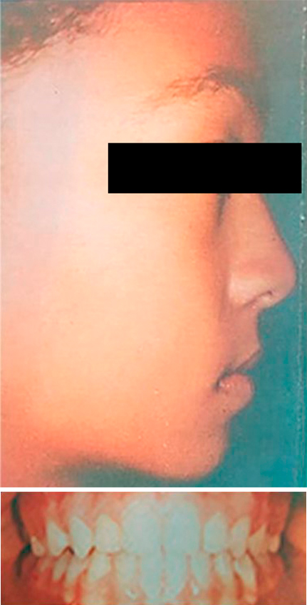 Caso de ortopedia dentofacial — después