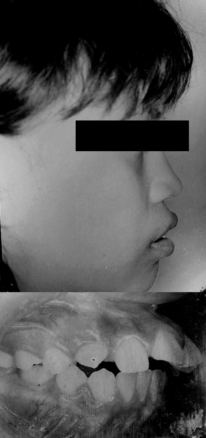 Caso de ortopedia dentofacial — antes
