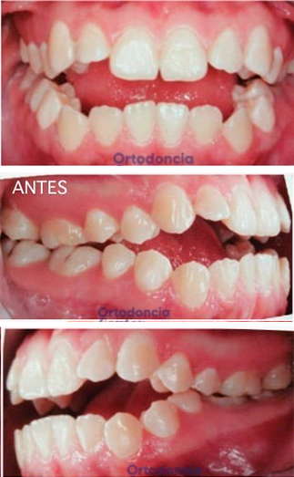 Caso de ortodoncia — antes