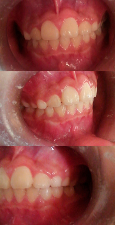 Caso de ortopedia dentofacial — después