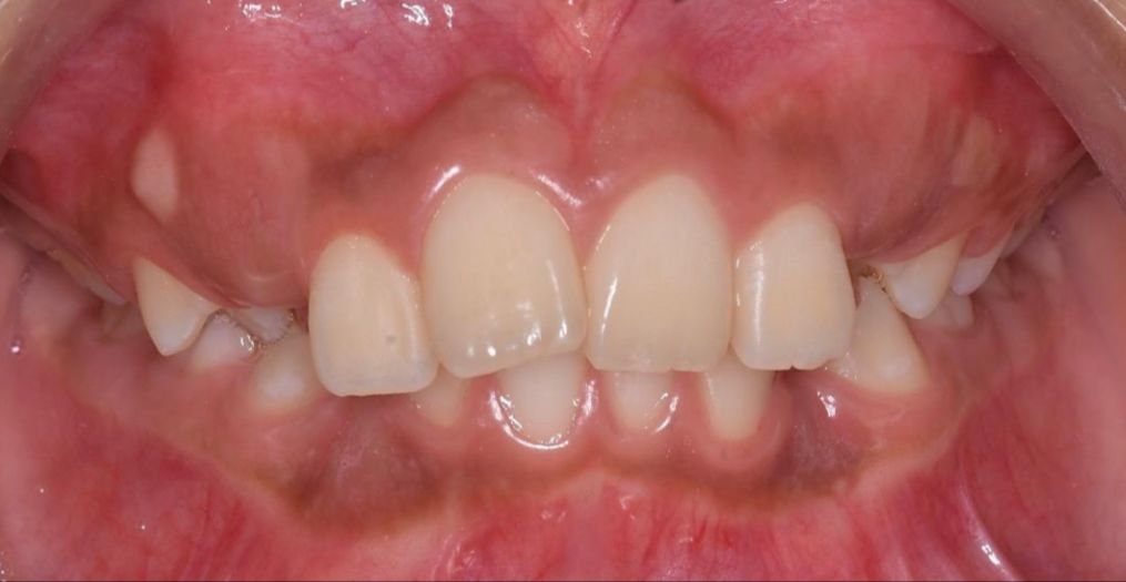 Caso de ortopedia dentofacial — antes