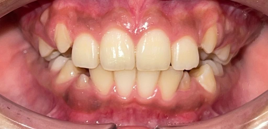 Caso de ortopedia dentofacial — después