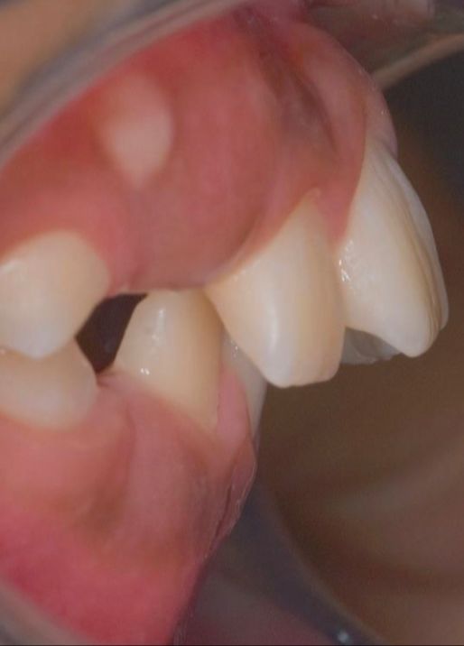 Caso de ortopedia dentofacial — antes