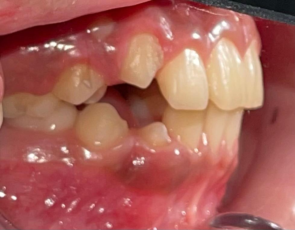 Caso de ortopedia dentofacial — después